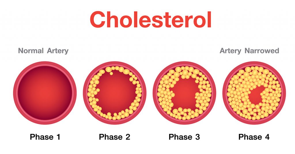 Wiodące czynniki ryzyka wysokiego cholesterolu